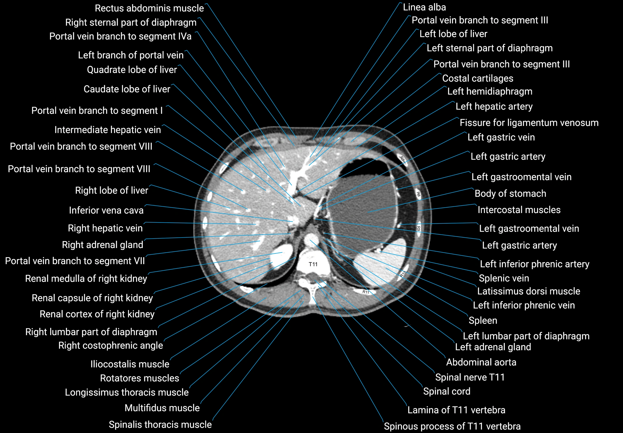 CT male pelvis axial cross sectional anatomy labelled radiology image -00033.webp